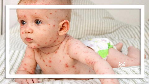 شایع‌ترین بثورات ویروسی در نوزادان