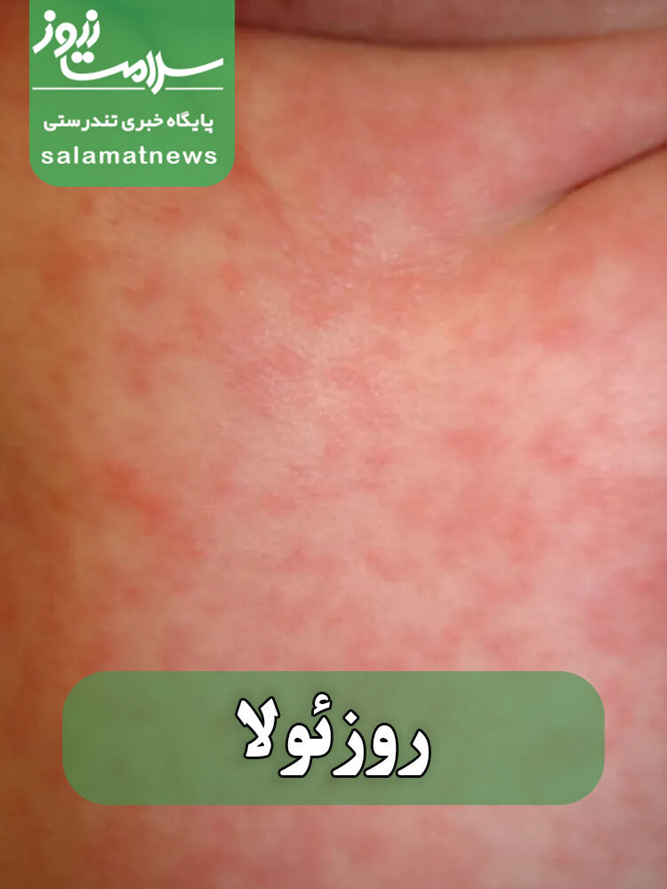 شایعترین بثورات ویروسی در نوزادان