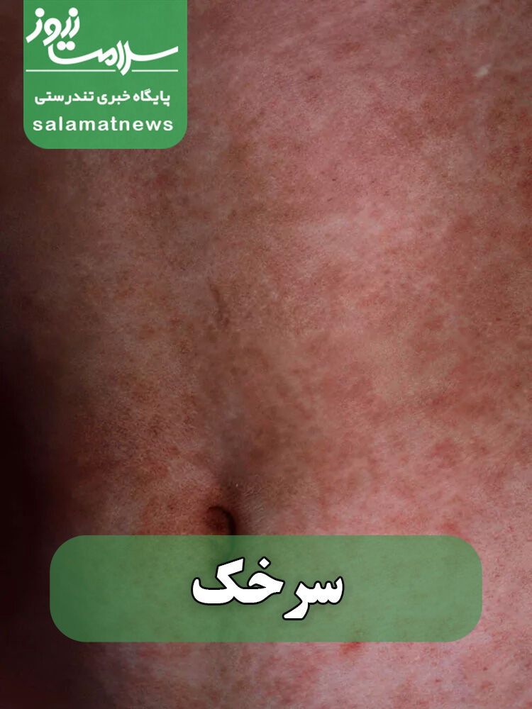 شایع‌ترین بثورات ویروسی در نوزادان