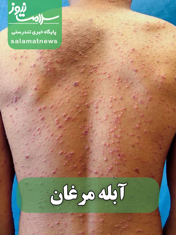 شایع‌ترین بثورات ویروسی در نوزادان