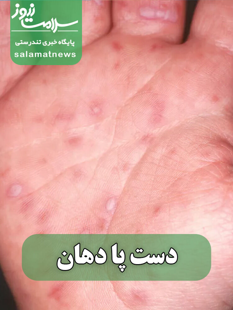 شایعترین بثورات ویروسی در نوزادان