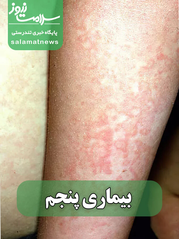 شایعترین بثورات ویروسی در نوزادان