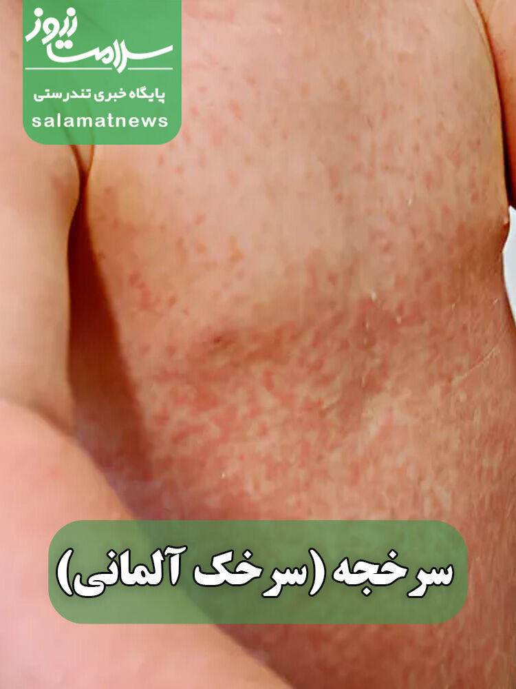 شایع‌ترین بثورات ویروسی در نوزادان