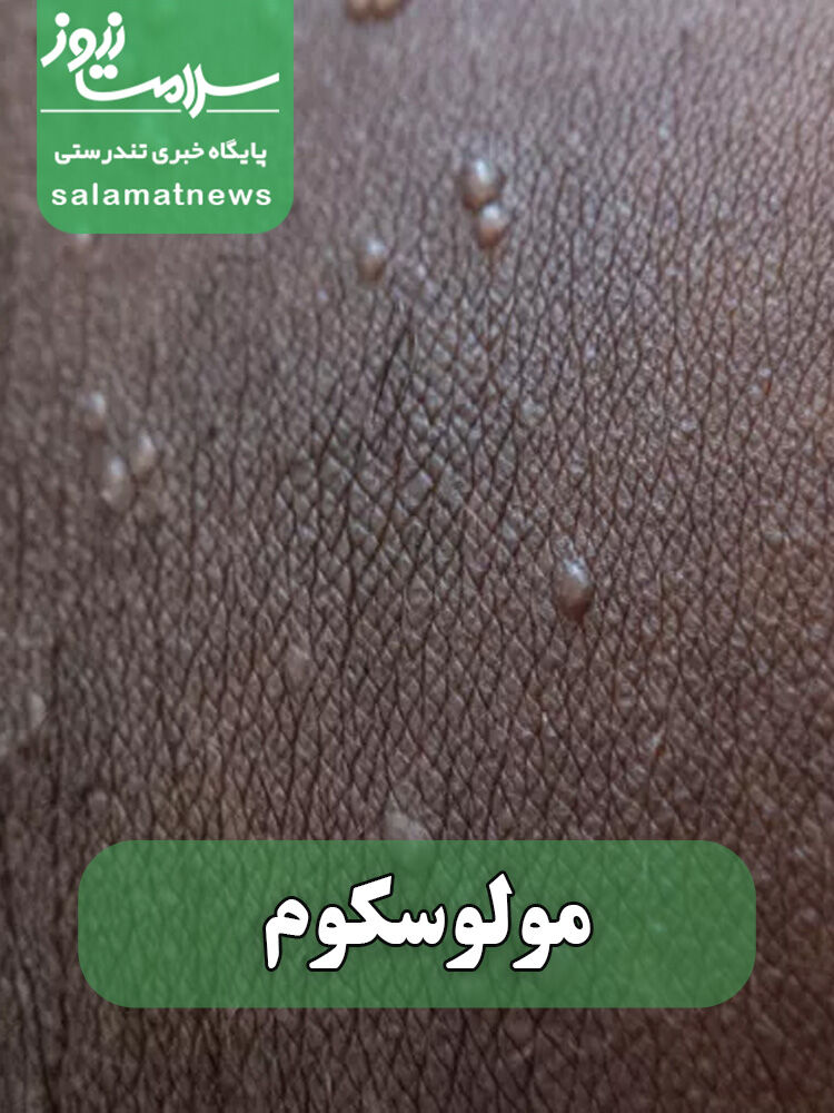 شایع‌ترین بثورات ویروسی در نوزادان