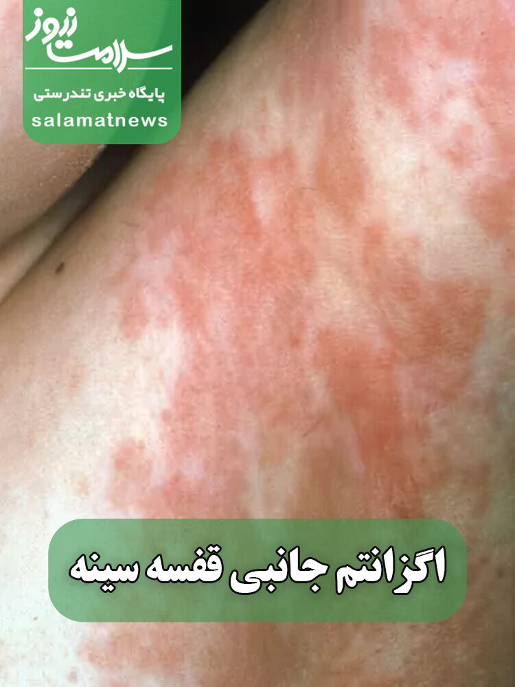 شایع‌ترین بثورات ویروسی در نوزادان