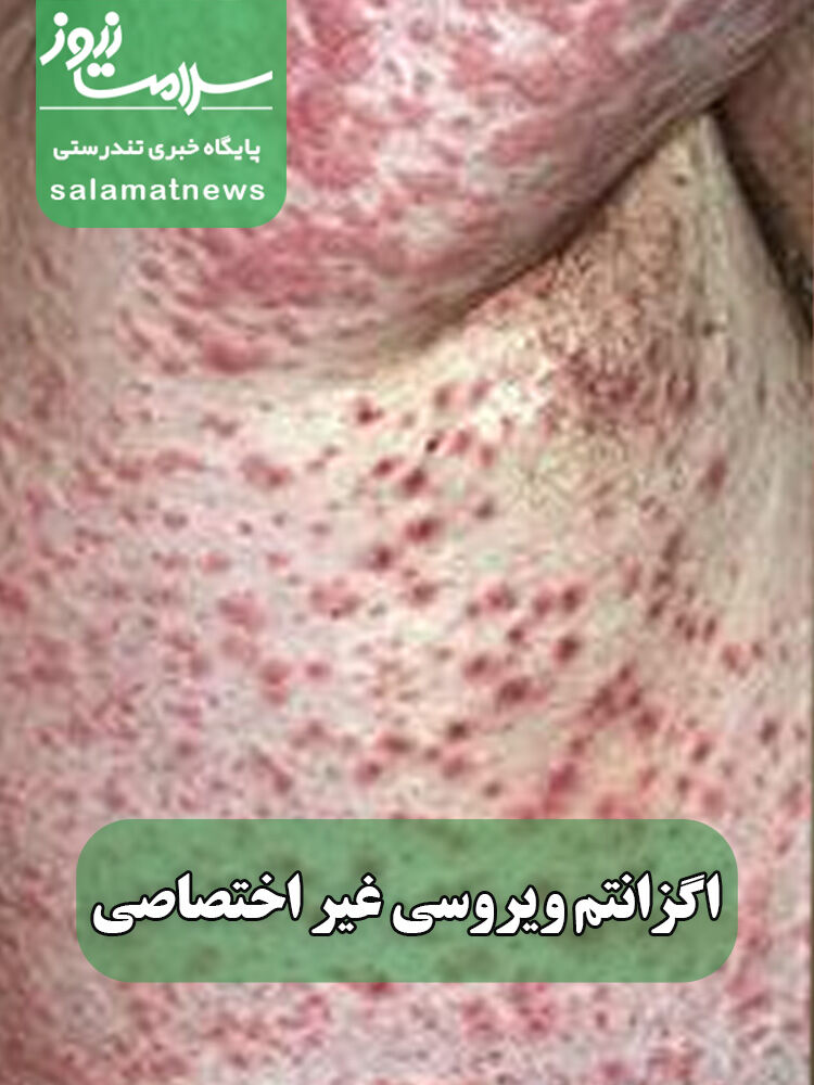 شایعترین بثورات ویروسی در نوزادان