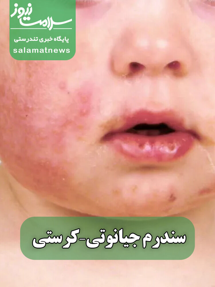 شایعترین بثورات ویروسی در نوزادان