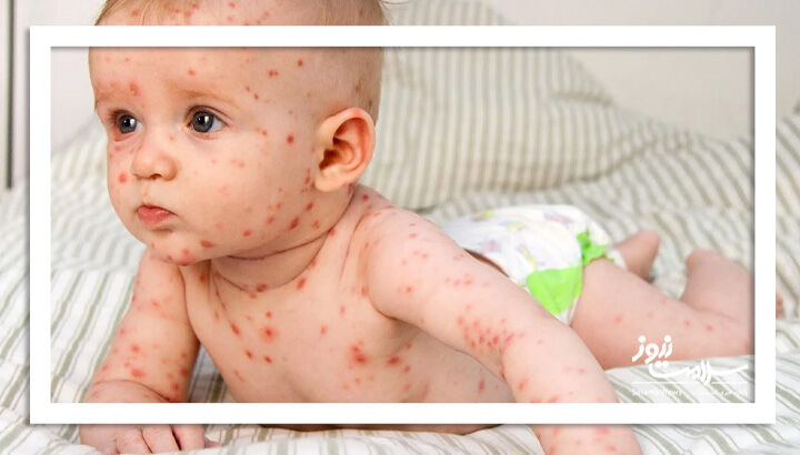 عکس/ شایع‌ترین بثورات ویروسی در نوزادان