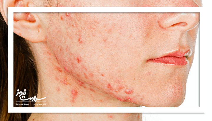 ۷ نشانه مهم که می‌گوید PCOS شما در حال بدتر شدن است