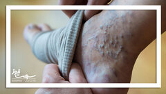 واریس پا: خودمراقبتی و روش‌های خانگی موثر