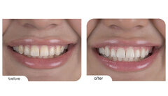 بلیچینگ با لیزر ؛ روشی نوین برای سفید کردن دندان ها