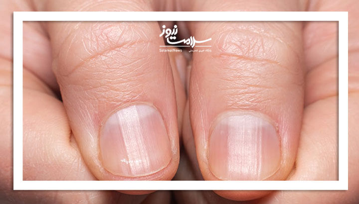 تغییرات هلال ناخن را جدی بگیرید