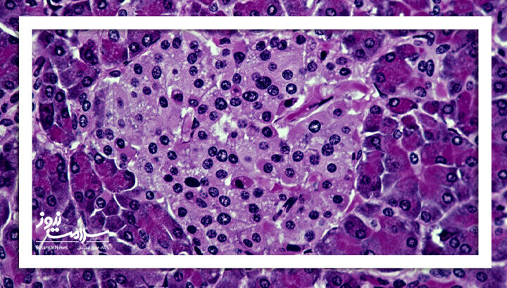 امید تازه برای درمان دیابت نوع ۱ با سیستم ایمنی ترکیبی