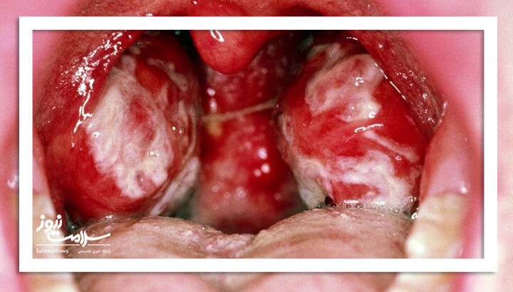 عکس/ هر آنچه باید درباره بیماری بوسه بدانید