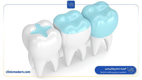 کلینیک مدرن مرکز تخصصی انجام اینلی و آنلی دندان در سراسر ایران