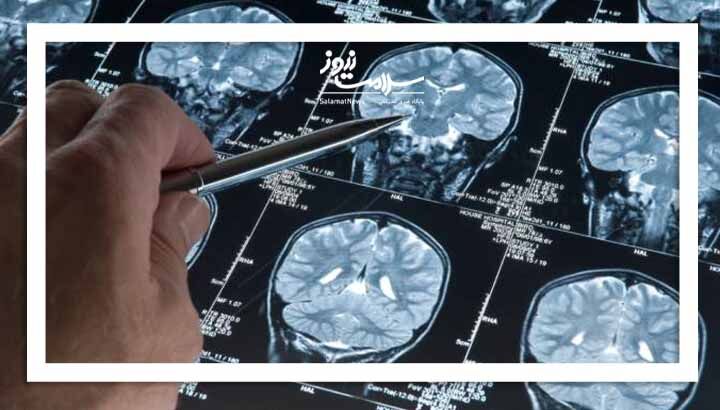 نشانه‌هایی که خبر از سرطان مغز می‌دهند