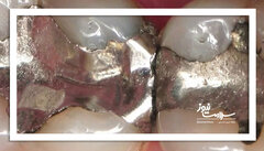 آیا آمالگام سمی است؟