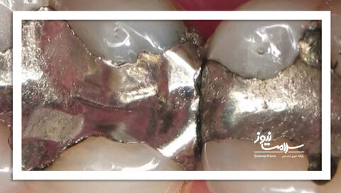 آیا آمالگام سمی است؟