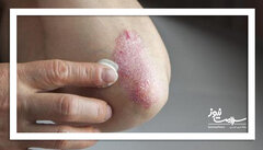 ۱۲ علت شایع پوسته‌پوسته شدن پوست