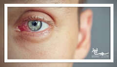 روش های کنترل خشکی چشم در زمستان