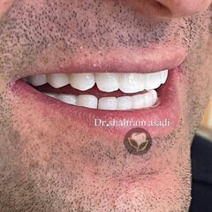 ایمپلنت دیجیتال بهتره یا معمولی؟ مقایسه مزایا، معایب و هزینه‌ها