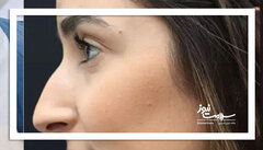 چرا بینی قوز دار مد 2026 شد