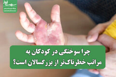 چرا سوختگی در کودکان به مراتب خطرناک‌تر از بزرگسالان است؟