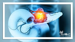 گامی بزرگ در درمان یکی از مرگبارترین سرطان‌ها