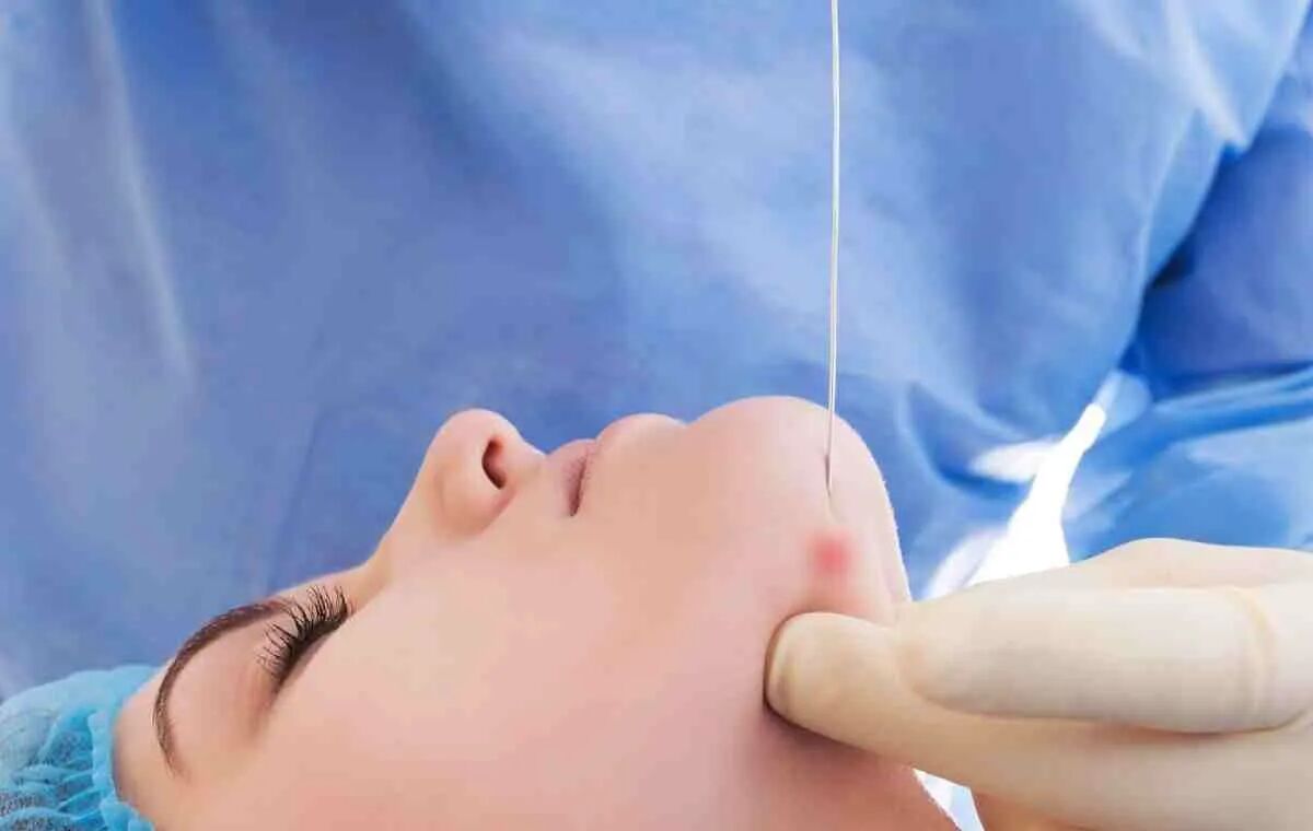 اندولیفت برای لاغری و جوانسازی دروغه یا واقعیت داره؟