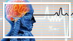 سکته مغزی در ایران به مرحله هشدار رسید