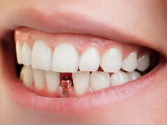 هزینه ایمپلنت دندان تهران 1404 + قیمت ایمپلنت با بیمه