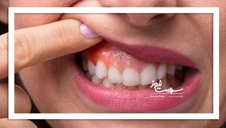 ورم لثه را جدی بگیرید