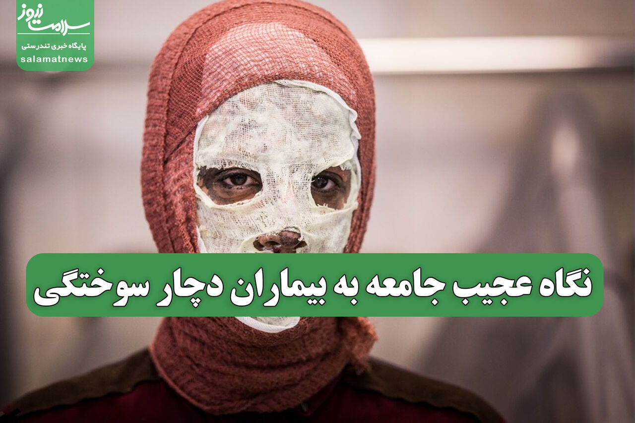 نگاه عجیب جامعه به بیماران دچار سوختگی نگاه عجیب جامعه به بیماران دچار سوختگی