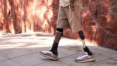 جدیدترین پای مصنوعی پیشرفته؛ انقلابی در بازگشت توان حرکتی با روش ایمپلنت