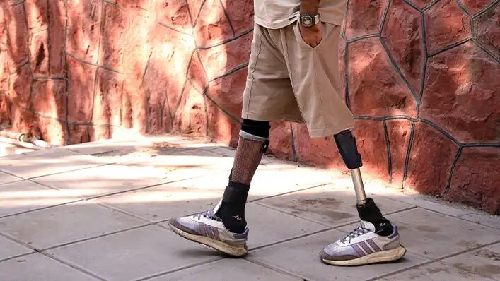 جدیدترین پای مصنوعی پیشرفته؛ انقلابی در بازگشت توان حرکتی با روش ایمپلنت