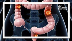 سرطان کولورکتال در اصفهان زنگ خطر را به صدا درآورد؛ غربالگری را جدی بگیرید