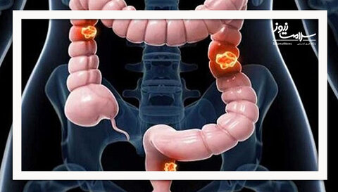 ارتباط پنهان نوشیدن الکل با افزایش خطر ابتلا به سرطان کولورکتال