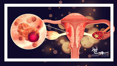 یک جراحی ساده که خطر سرطان تخمدان را تا ۸۰ درصد کاهش می‌دهد