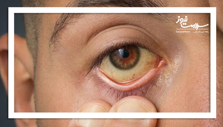 زرد شدن پوست نشانه زردی (یرقان) است؟