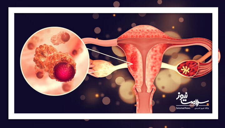 یک جراحی ساده که خطر سرطان تخمدان را تا ۸۰ درصد کاهش می‌دهد