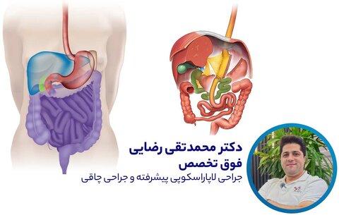 نظر دکتر محمدتقی رضایی متخصص جراحی چاقی در مورد عمل مینی بای پس