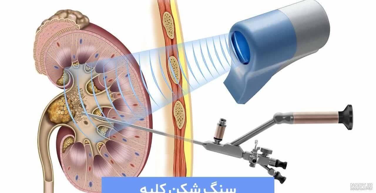 سنگ شکنی کلیه چیست و کدام روش واقعاً بدون درد و بی‌خطر است!