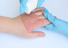 اگر لوله بازکن روی دست بریزد چه کنیم؟