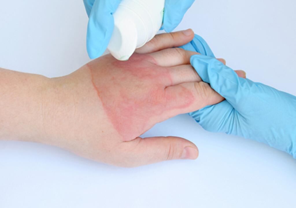 اگر لوله بازکن روی دست بریزد چه کنیم؟