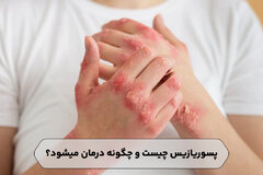 پسوریازیس چیست و چگونه درمان میشود؟