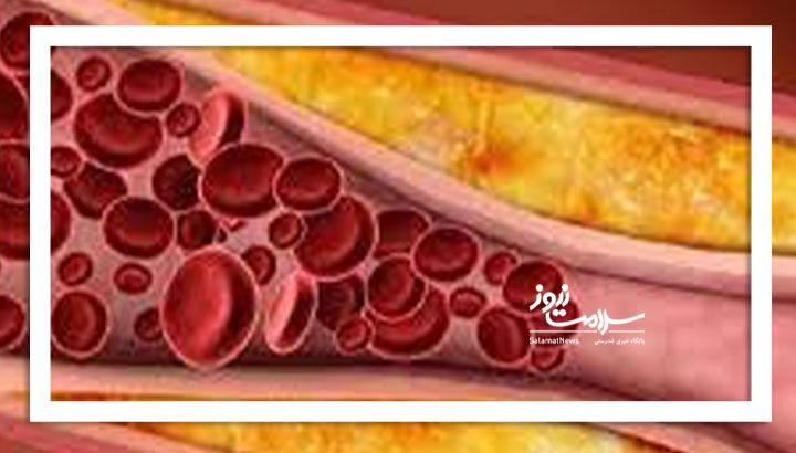 بالا رفتن تری‌گلیسرید در بدن چه خطری دارد؟