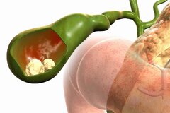 سنگ کیسه صفرا را جدی بگیریم؛ چه زمانی جراحی تنها راه درمان است؟