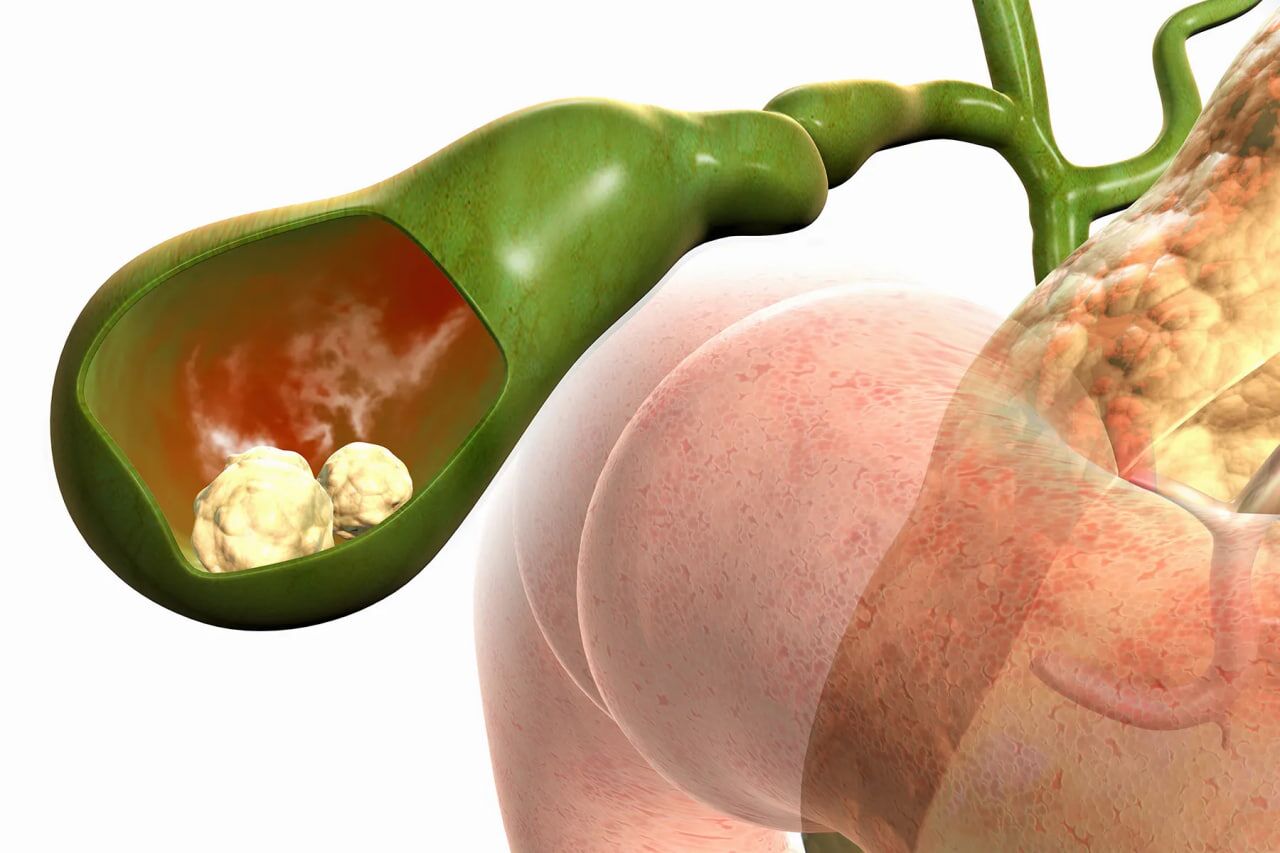 سنگ کیسه صفرا را جدی بگیریم؛ چه زمانی جراحی تنها راه درمان است؟