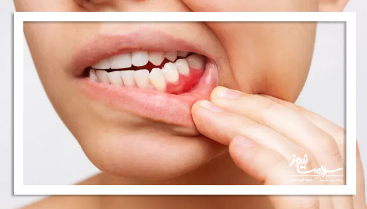 گوشتهای فرآوریشده؛ متهم جدید در افزایش خطر سرطان دهان گوشتهای فرآوریشده؛ متهم جدید در افزایش خطر سرطان دهان