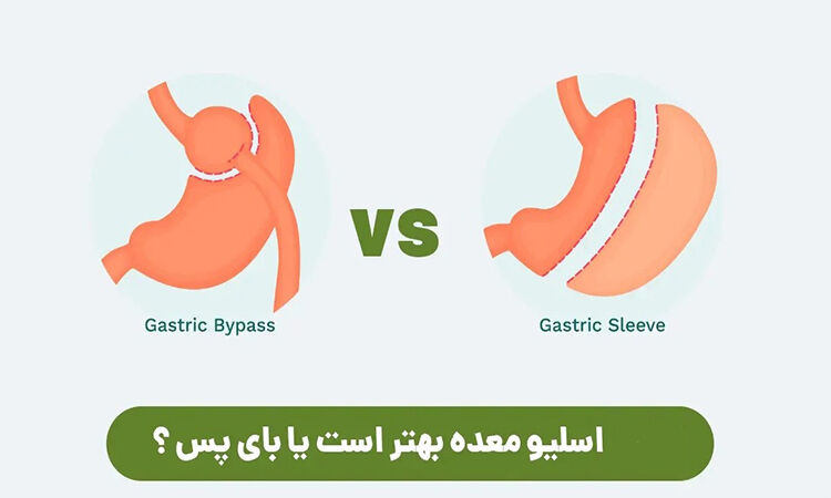 اسلیو معده یا بای پس معده 